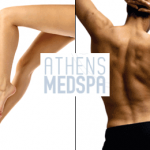 Οριστική αποτρίχωση Laser