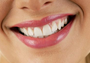 Λεύκανση δοντιών με μόλις 150€